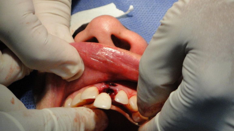 Co dają nam implanty zębowe?